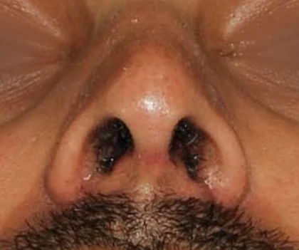 After: Nostril correction