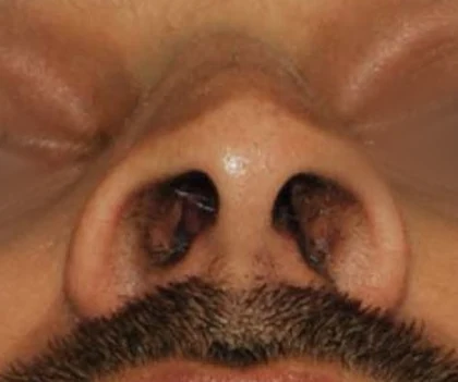 Before: Nostril correction