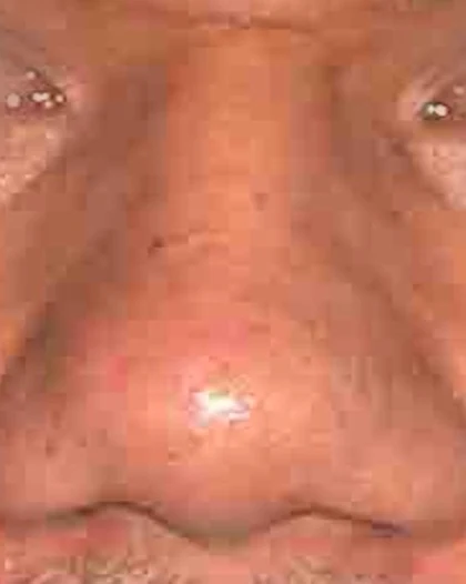 Before: Large, bulbous tip