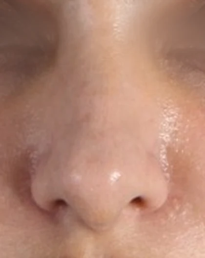 After: Broad nose, wide tip