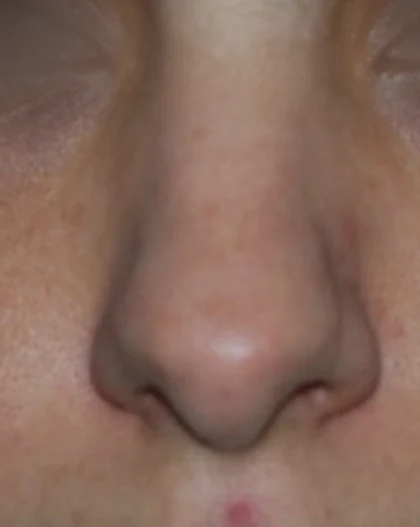Before: Broad nose, wide tip