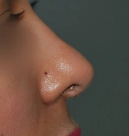 After: Bulbous, drooping tip