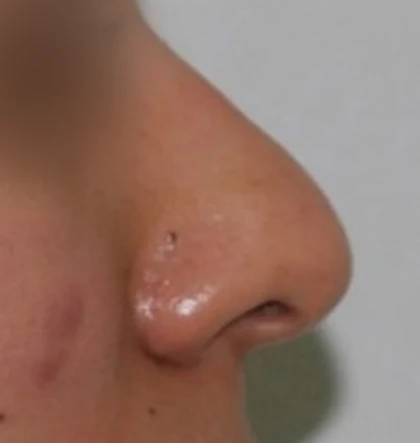 Before: Bulbous, drooping tip
