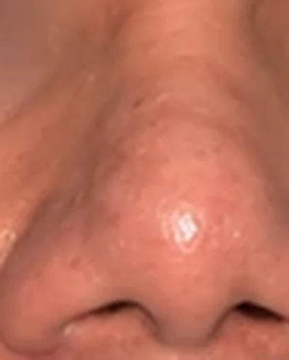 After: Broad, bulbous nose