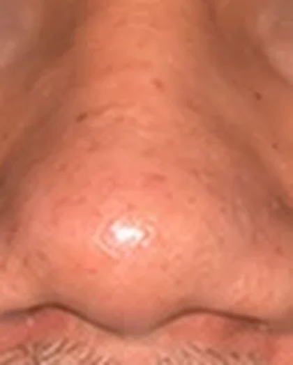 Before: Broad, bulbous nose