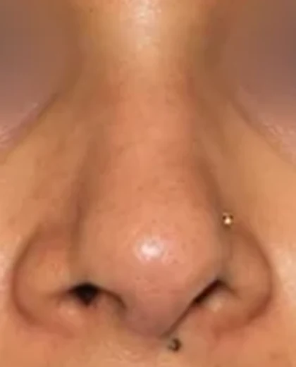 After: Deviated nose with tip asymmetry