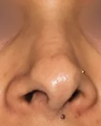 Before: Deviated nose with tip asymmetry
