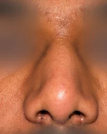 After: Deviated and broad nose