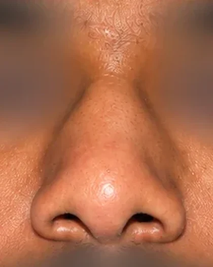 Before: Deviated and broad nose