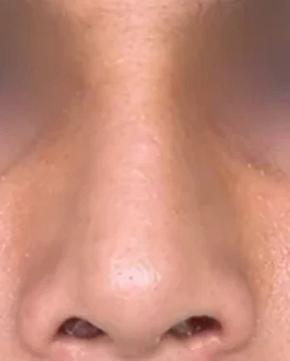 After: Deviated nasal septum