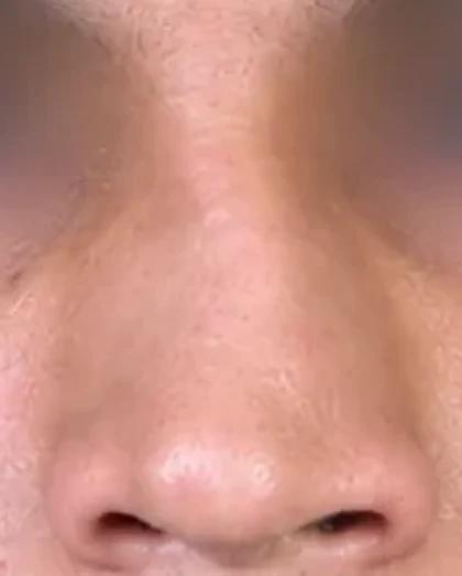 Before: Deviated nasal septum