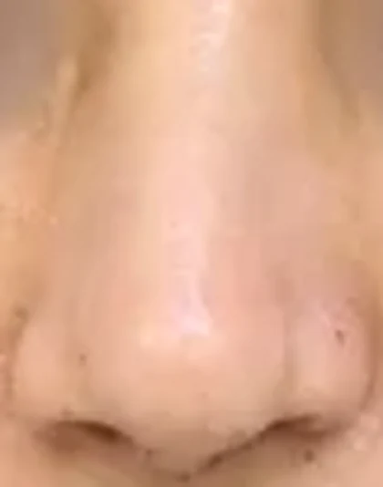 After: Severe deviated nose