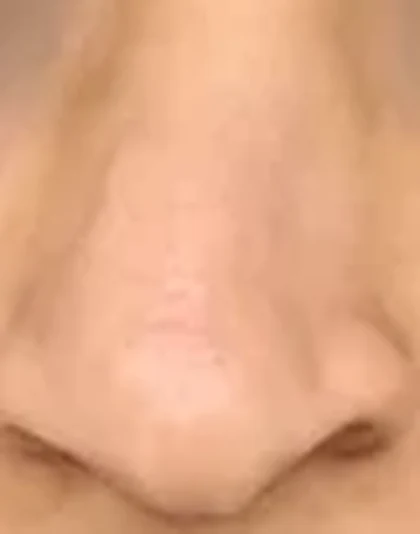Before: Severe deviated nose