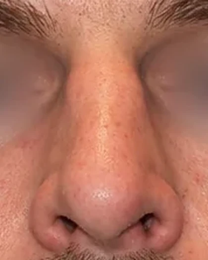 After: Straight deviated (deflected) nose
