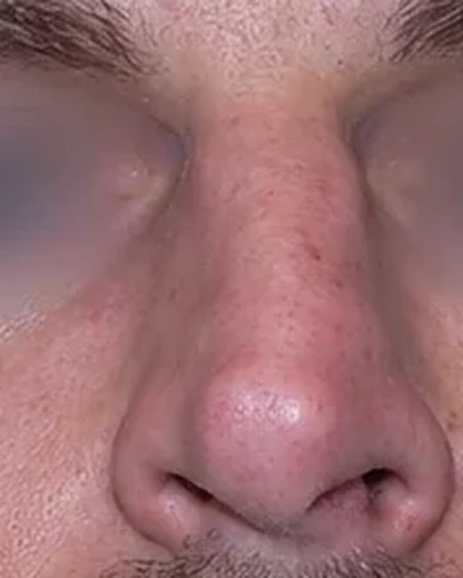 Before: Straight deviated (deflected) nose