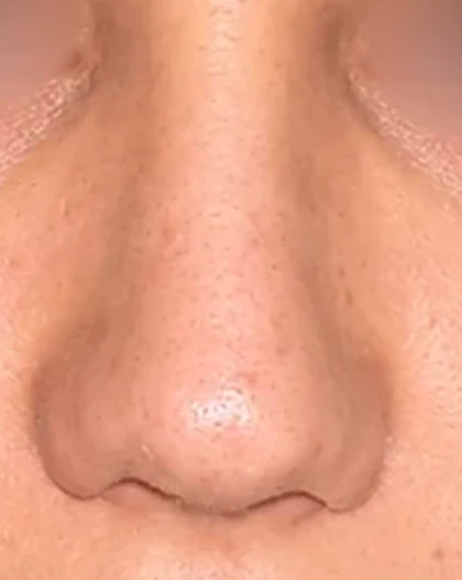 After: Deviated nose tip