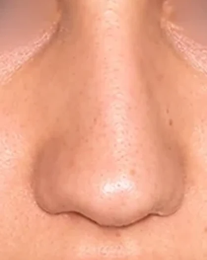 Before: Deviated nose tip