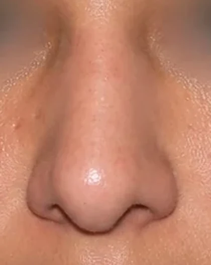 After: Deviated nose