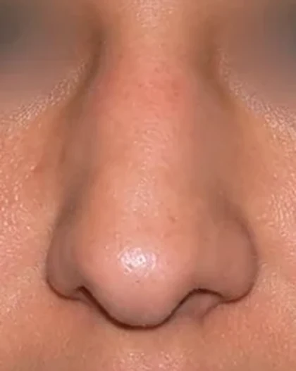 Before: Deviated nose