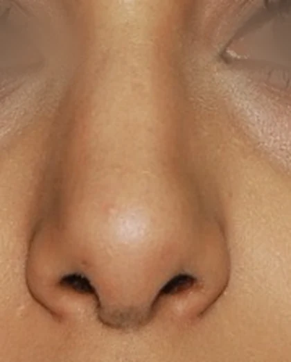 After: Ethnic rhinoplasty