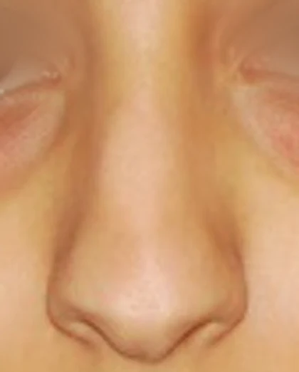 Before: Ethnic rhinoplasty