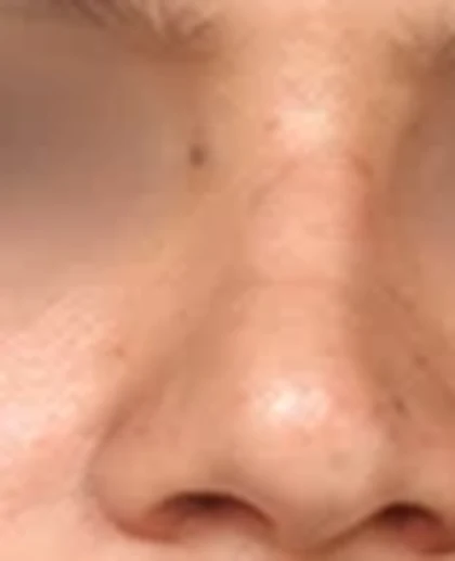 After: Wide, flat nose