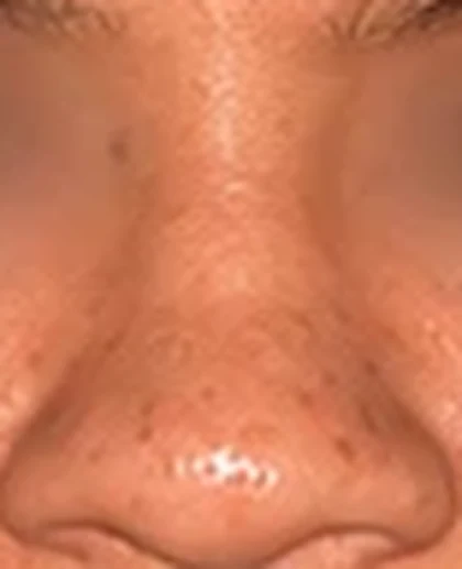 Before: Wide, flat nose