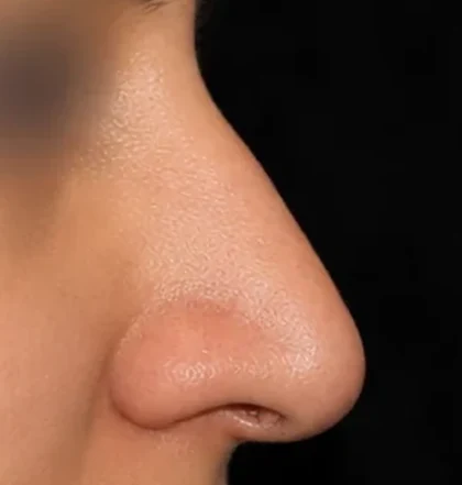 After: Dorsal hump reduction
