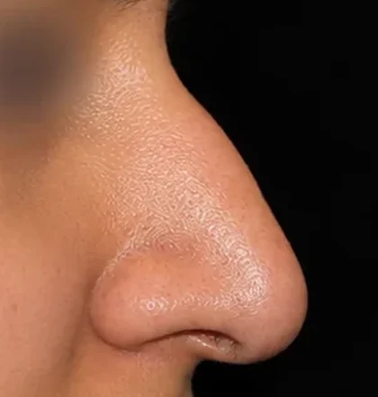 Before: Dorsal hump reduction