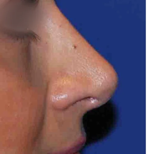After: Nasal hump and drooping tip