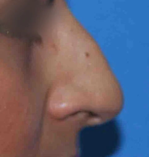 Before: Nasal hump and drooping tip