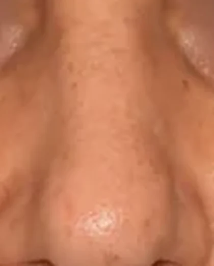 After: Nasal hump and drooping tip