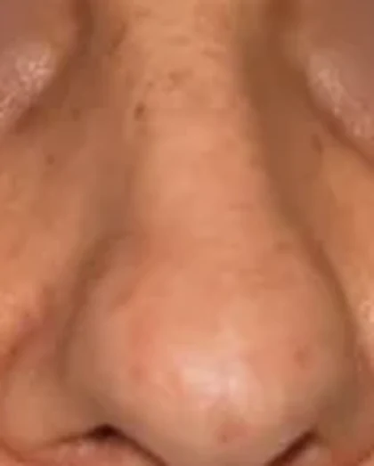 Before: Nasal hump and drooping tip