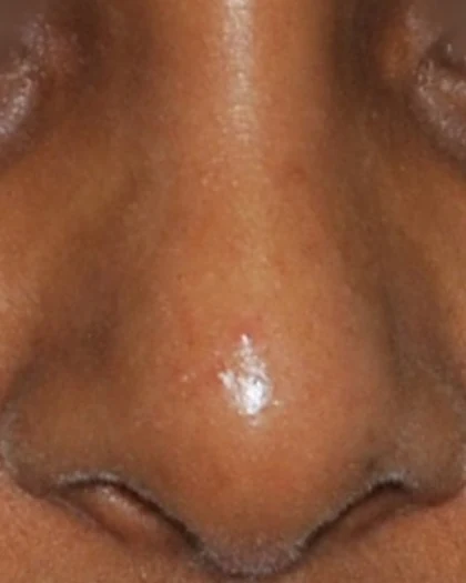 After: Nasal implant for a low bridge