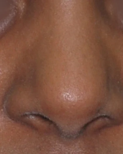Before: Nasal implant for a low bridge