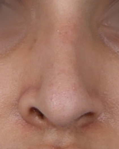 After: Long nose, hanging tip