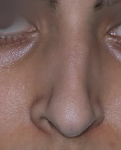 Before: Long nose, hanging tip