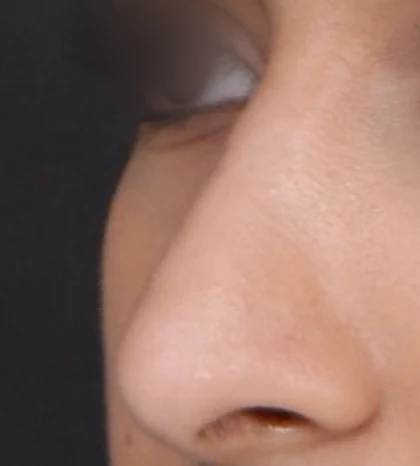 After: Long nose, drooping tip