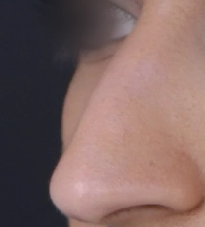 Before: Long nose, drooping tip