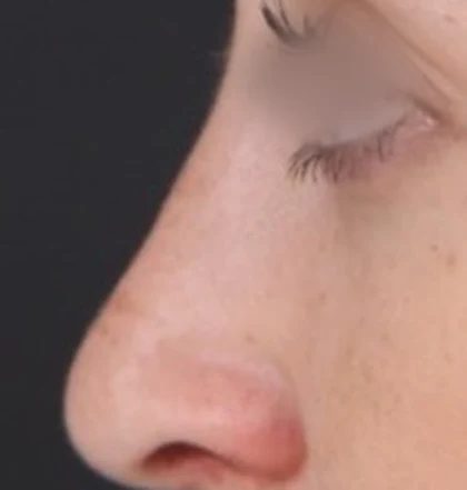 After: Long nose with a hump