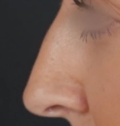 Before: Long nose with a hump