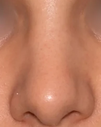 After: Refinement rhinoplasty