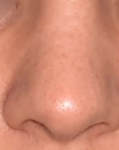 Before: Refinement rhinoplasty