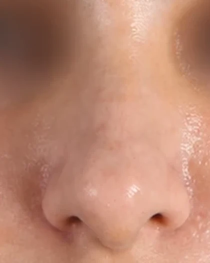 After: Refinement rhinoplasty