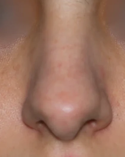 Before: Refinement rhinoplasty