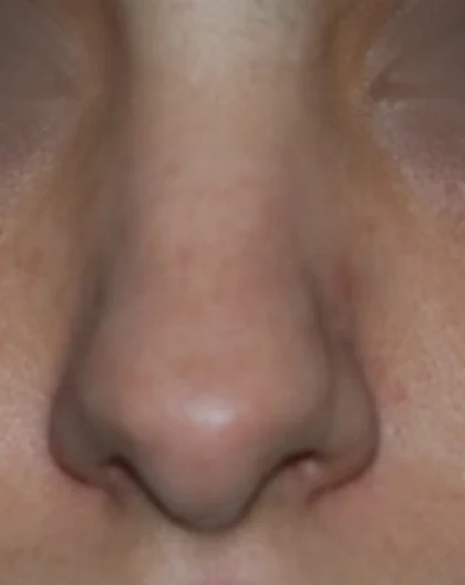 Before: Broad, rounded tip