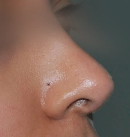 After: Hump and drooping tip
