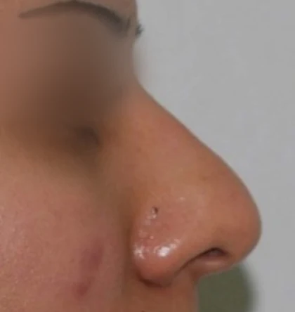 Before: Hump and drooping tip