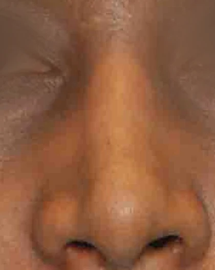After: Wide, bulbous tip
