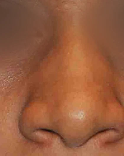 Before: Wide, bulbous tip